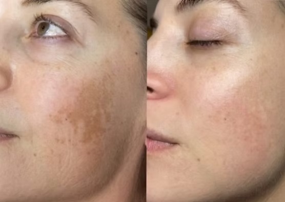 Biomicroneedling skin natural exfoliation