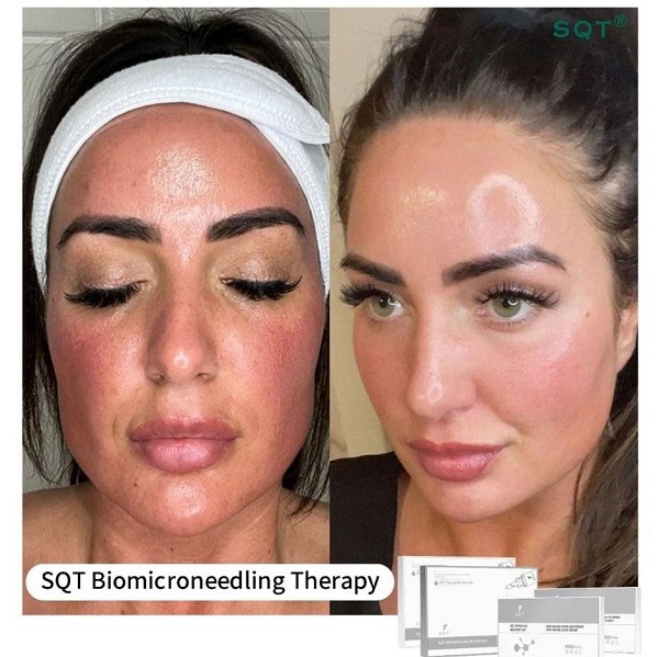 Biomicroneedling skin barrier repair