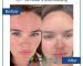 Post-biomicroneedling skin care importance