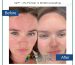Post-biomicroneedling skin care importance