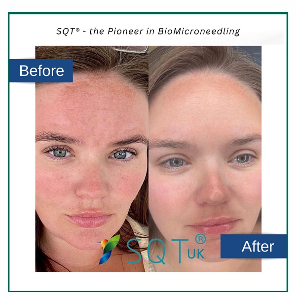 Post-biomicroneedling skin care importance