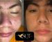 SQT before and after acne scar treatment