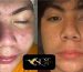 SQT before and after acne scar treatment