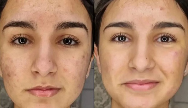 SQT Biomicroneedling before and after results