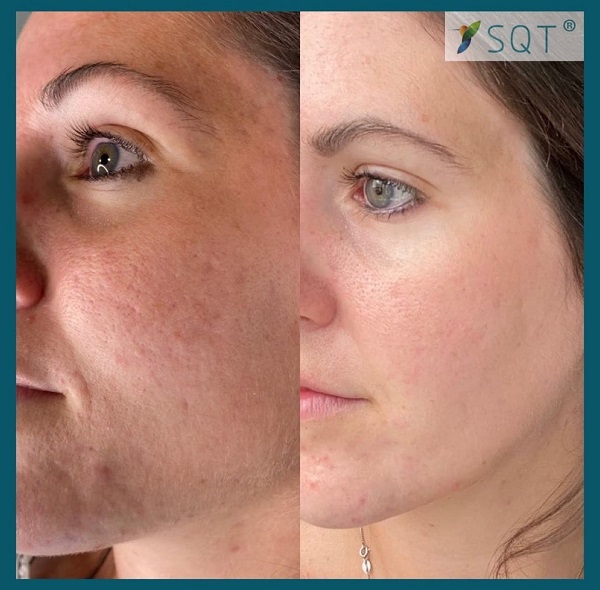 SQT Biomicroneedling before and after