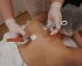 SQT body microneedling treatment