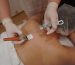 SQT body microneedling treatment