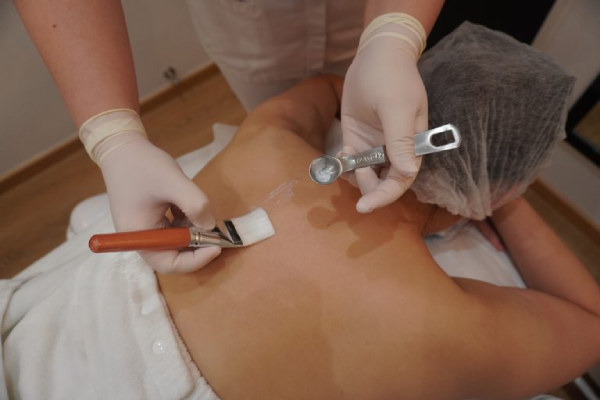 SQT body microneedling treatment